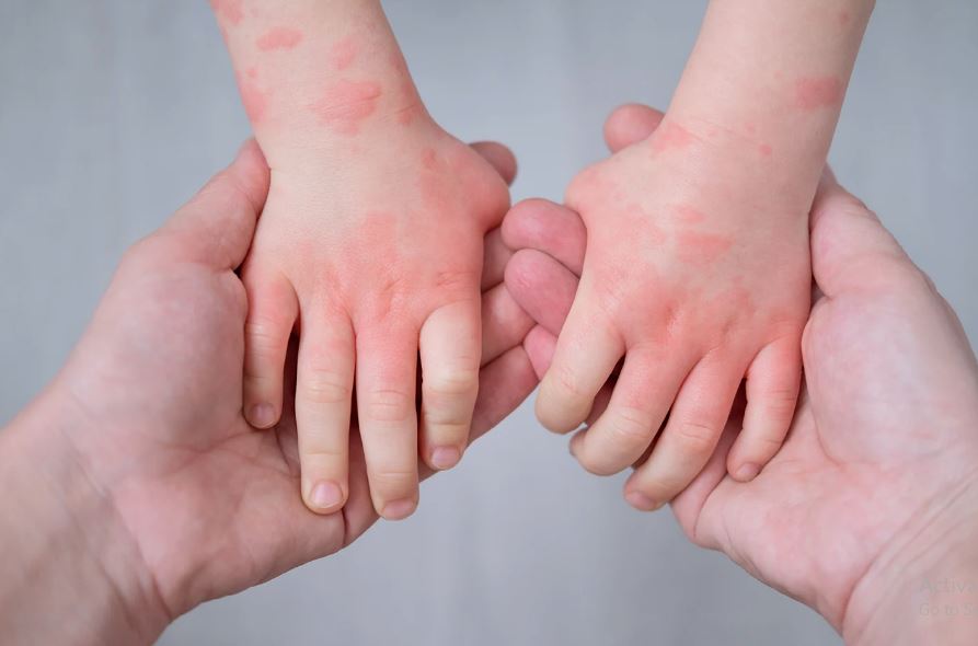 Eczema