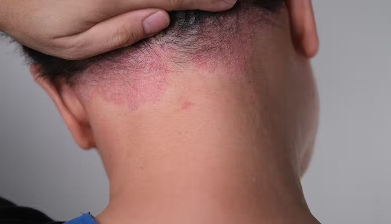 Psoriasis Treatment