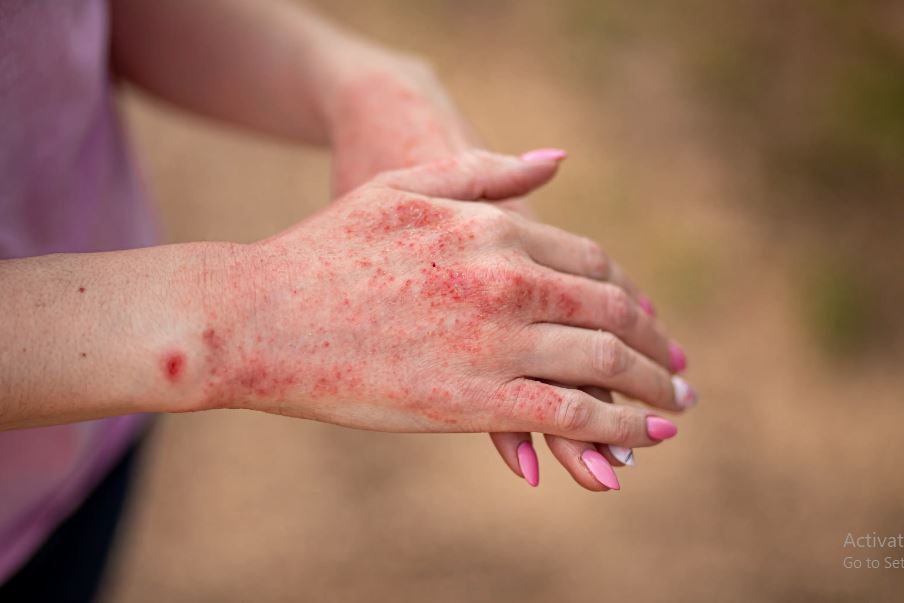 eczema treatment