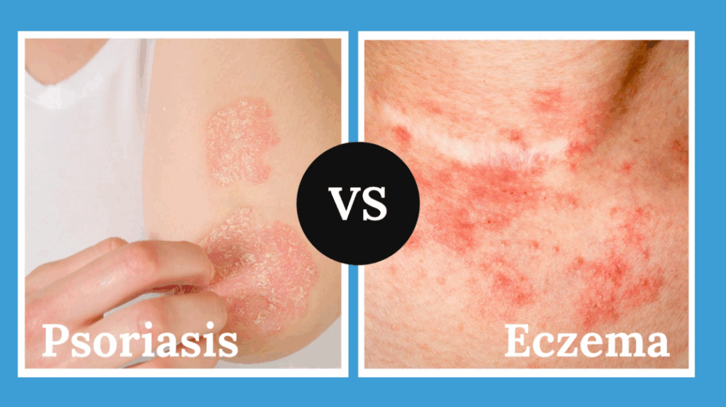 Psoriasis vs Eczema: How to Tell the Difference