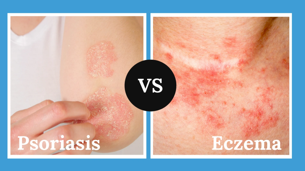 psoriasis vs eczema