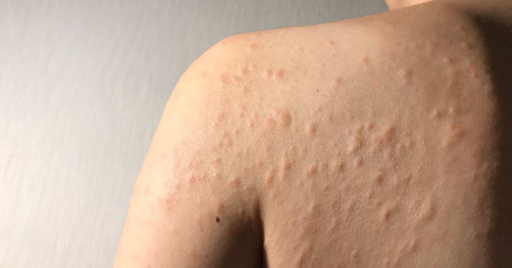 urticaria