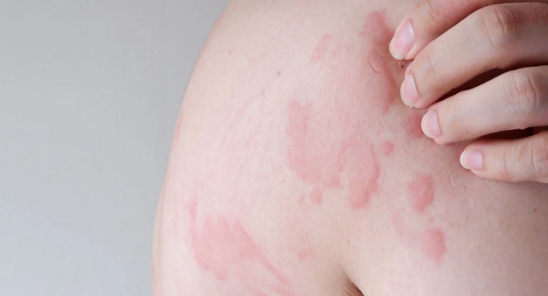 Urticaria