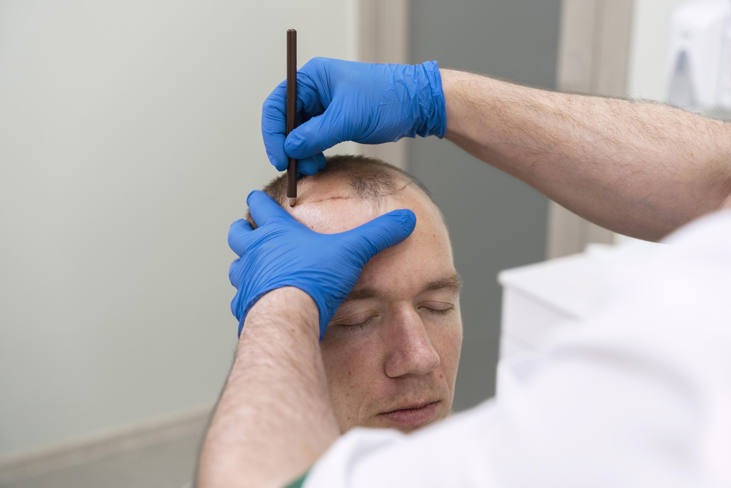Scalp Micropigmentation in Mumbai