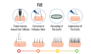 FUE hair transplant in Andheri.