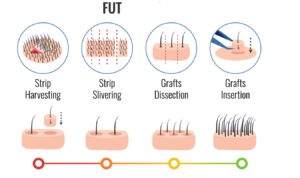 FUT hair transplant in Andheri