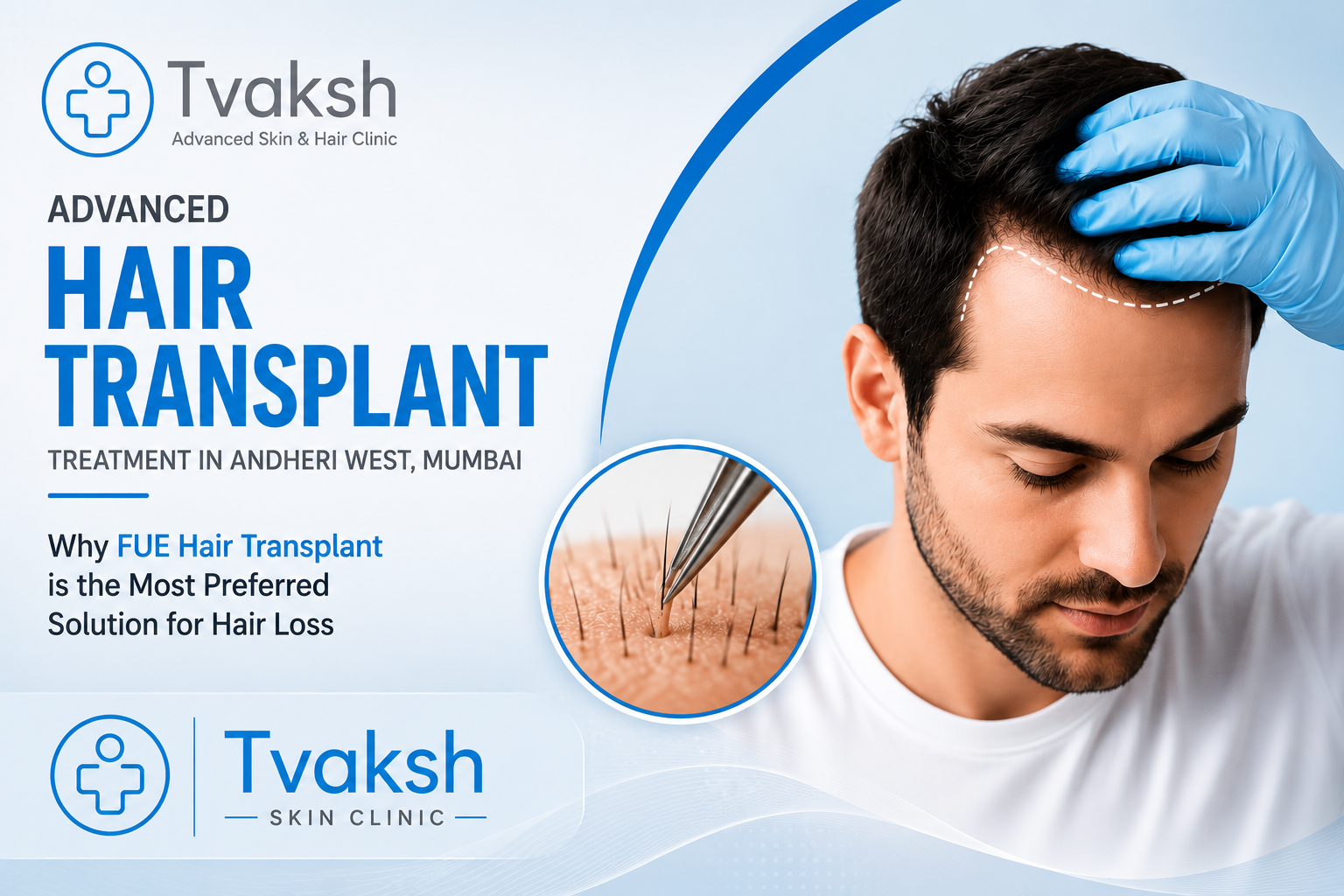 FUE Hair Transplant in Andheri
