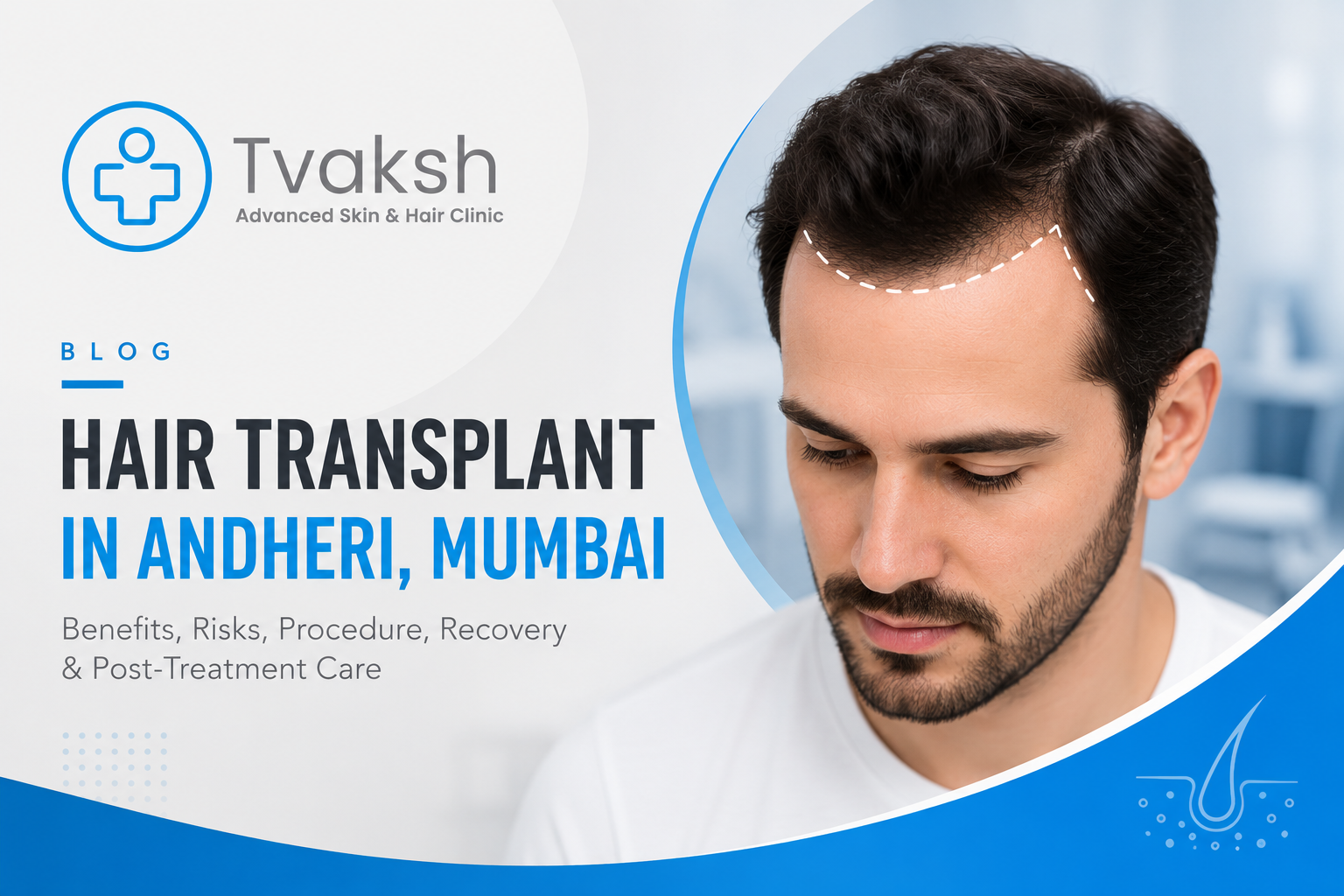 Hair Transplant Clinic Andheri