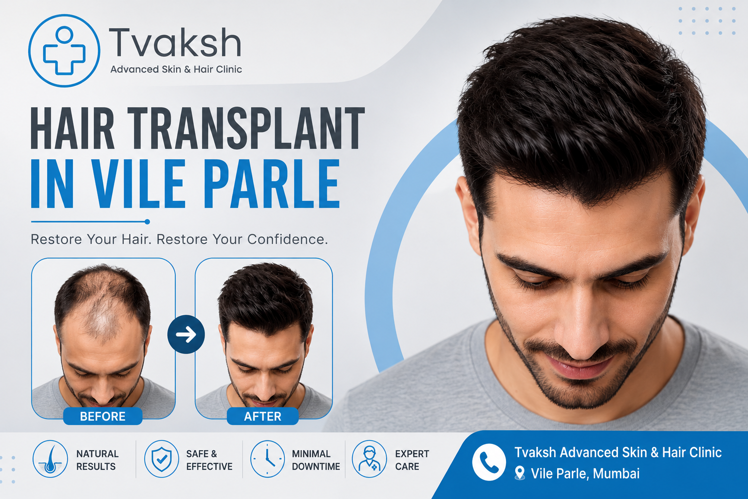 Hair Transplant in Vile Parle