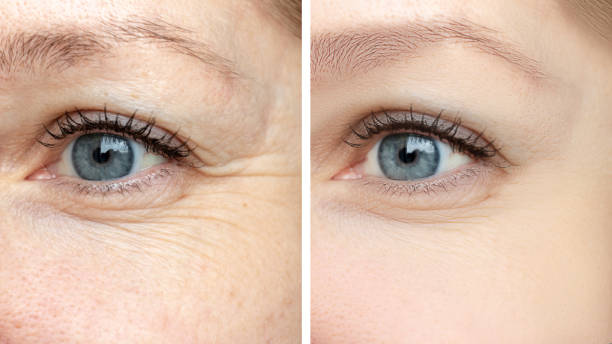 Botox injection procedure at Tvaksh Clinic Andheri Mumbai